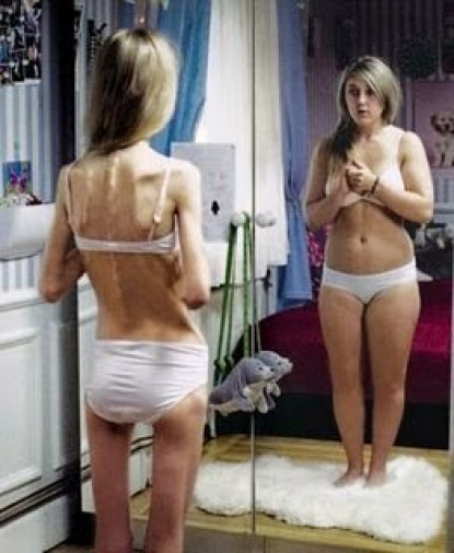 Anoressia/Bulimia